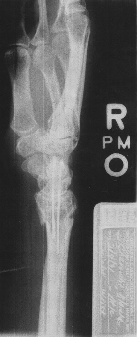 Xray